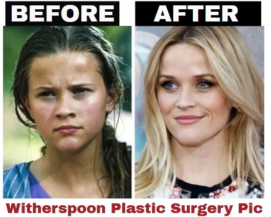 Has Reese Witherspoon Ever Had Plastic Surgery?
