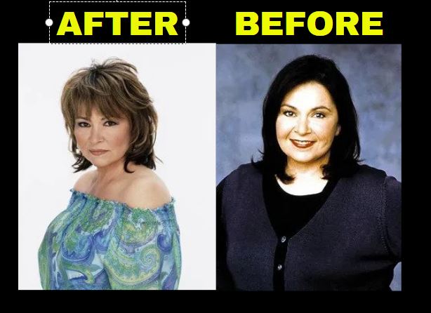 Did Roseanne Barr Get Weight Loss Surgery?