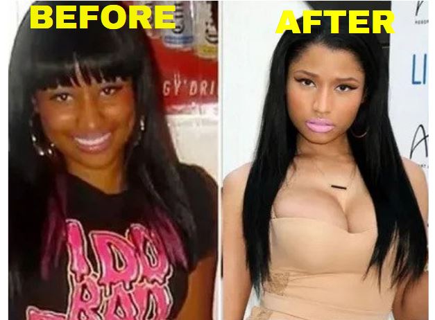 Did Nicki Minaj Get Breast Implants?